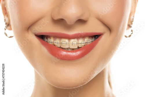 Braces. Orthodontic Treatment. Dental Care Concept. Closeup Ceramic and Metal Brackets on Teeth. Beautiful Female Smile with Braces. Beautiful Woman Healthy Smile close up on white background