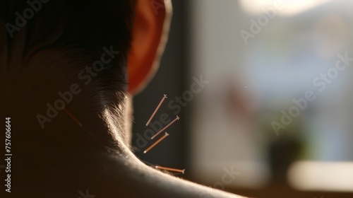 acupuncture for pain