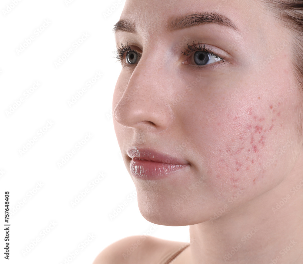 Obraz premium Young woman with acne problem on white background, closeup