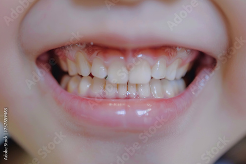 アジア人の子供の歯のクローズアップ写真