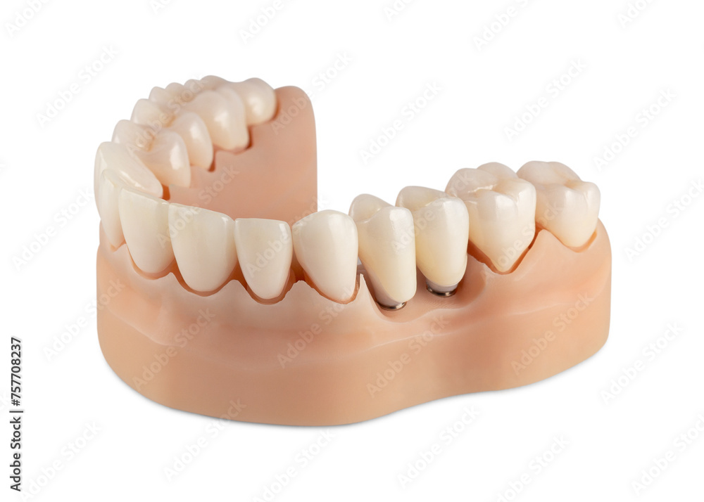 Fototapeta premium Bottom row of teeth isolated on white background. Dental model of teeth. Ceramic crowns on silicone gums.
