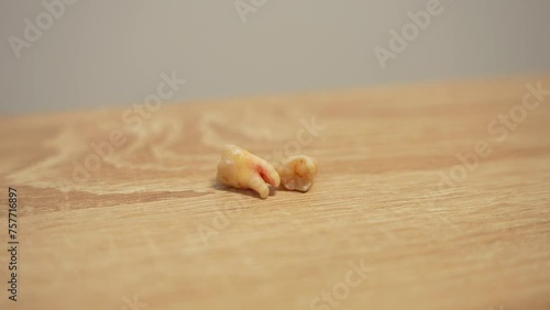 Detailed shot of two freshly extracted wisdom teeth with dry blood