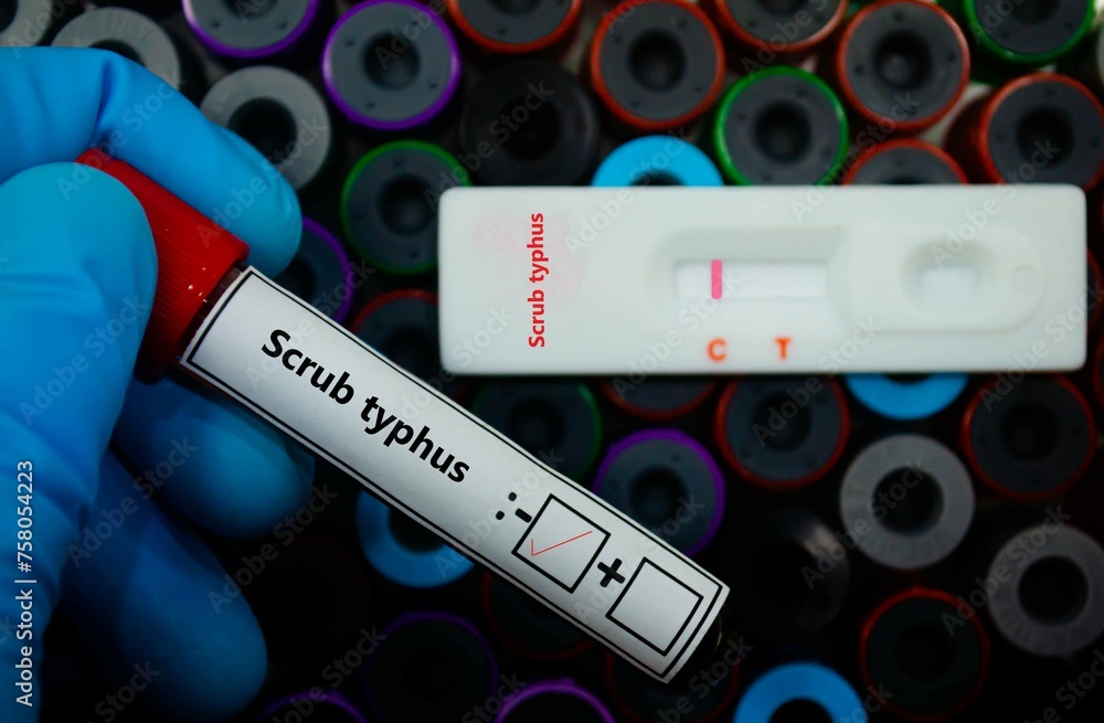 Obraz premium Blood sample of patient negative tested for scrub typhus by rapid diagnostic test.