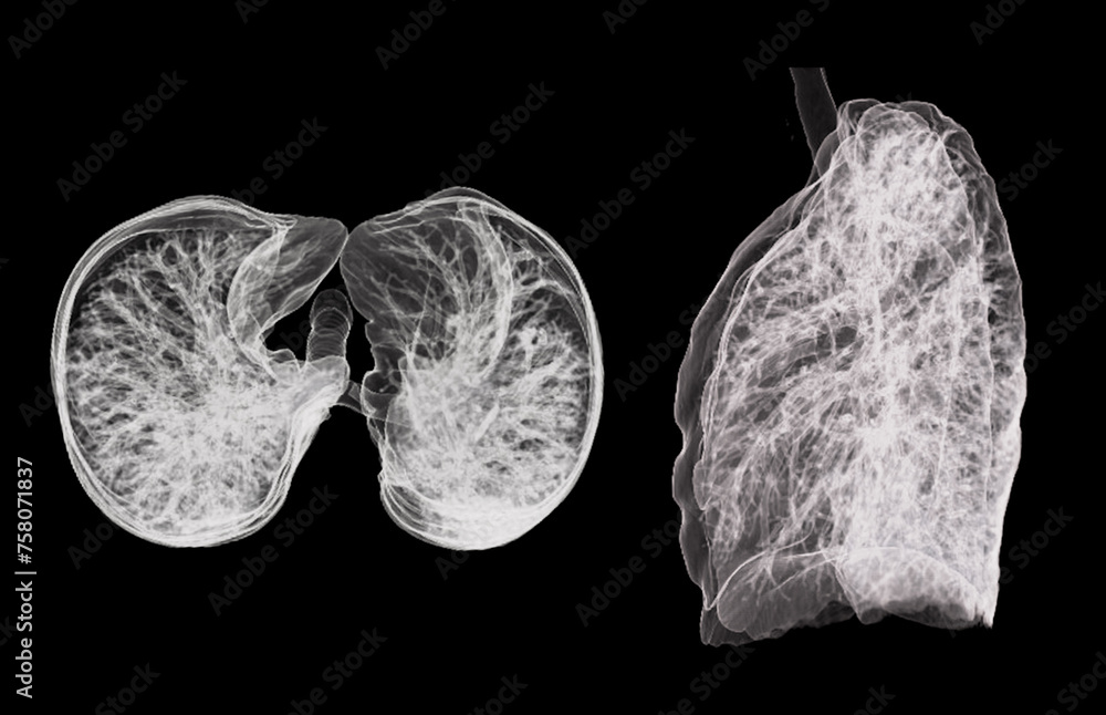 A CT chest 3D scan displaying a lesion at the right upper lobe offers a detailed visualization, aiding in precise identification and  treatment planning. - obrazy, fototapety, plakaty 