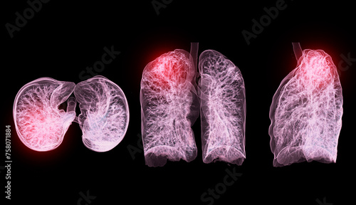 A CT chest 3D scan displaying a lesion at the right upper lobe offers a detailed visualization, aiding in precise identification and  treatment planning.