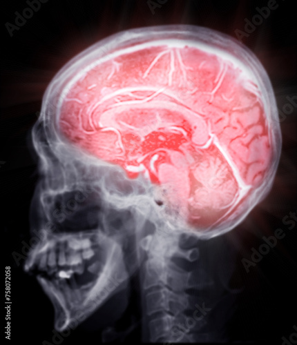 MRI  brain scan  sagittal plane for detect  Brain  diseases sush as stroke disease, Brain tumors and Infections. photo