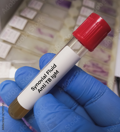 Synovial Fluid Analysis for Anti TB IgA, IgG, IgM. to diagnosis of active pulmonary disease, mycobacterial infection, Temporomandibular disorder (TMD). photo