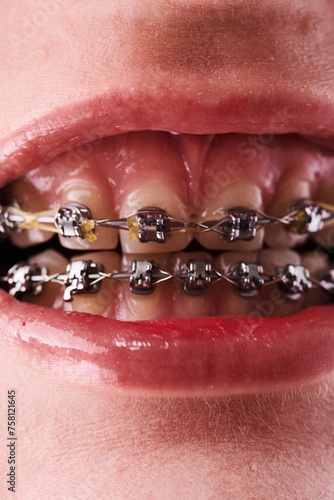 Close-up of a woman's mouth with braces on her teeth