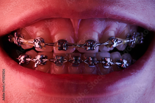 Close-up of a woman's mouth with braces on her teeth