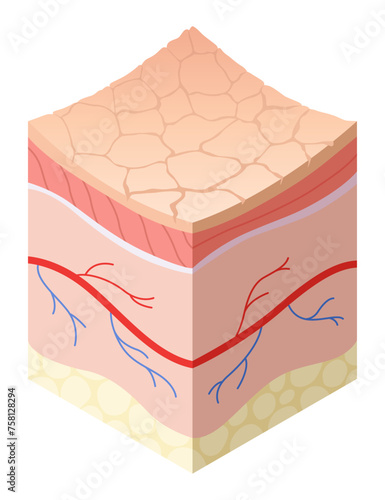 Skincare medical concept. Problems in cross-section of human skin horizontal layers structure. Anatomy illustrative model unhealthy layer of skin