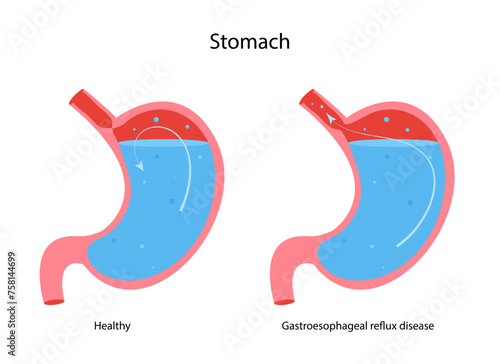 Gastroesophageal reflux disease stomach. GERD, heartburn. Normal internal organ and stomach with Acid reflux.