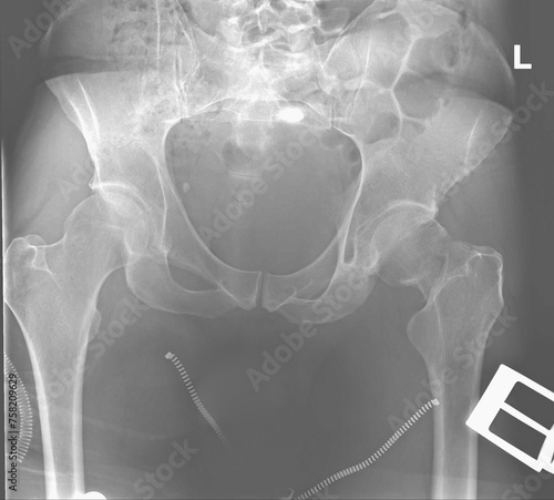Left transcervical neck fracture fracture. X-ray photo of roentgenogram with metal elements of clothes. The day of fracture. Left femoral neck fracture