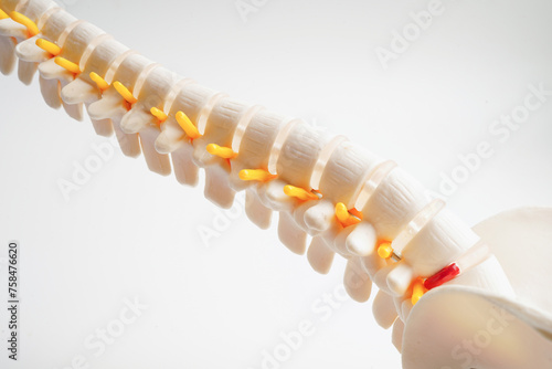 Spinal nerve and bone, Lumbar spine displaced herniated disc fragment, Model for treatment medical in the orthopedic department.