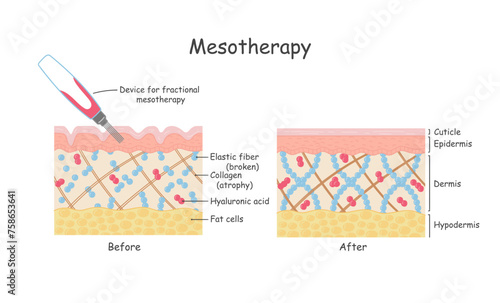 mesotherapy for skin. anatomical illustration in cartoon style