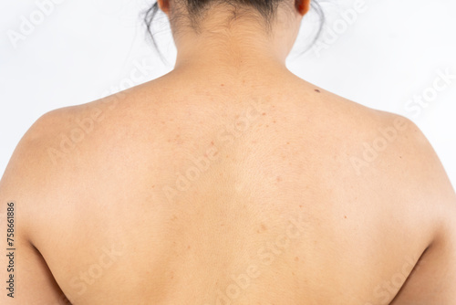 Young Asian woman have acne with red spots on the back isolate on white background.