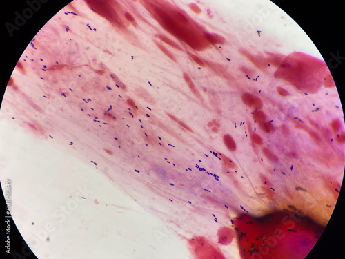 Gram positive bacilli in sputum. photo