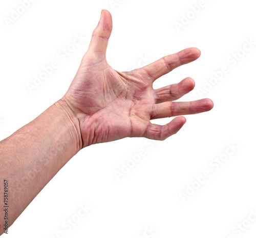 Obraz na plátne Hand of an man with Dupuytren contracture disease