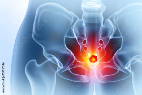 Foto Pelvic bone cancer or tumor. 3d illustration