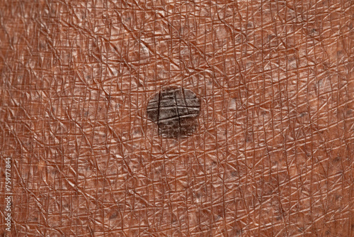 Seborrheic keratosis on the skin of an African lady photo