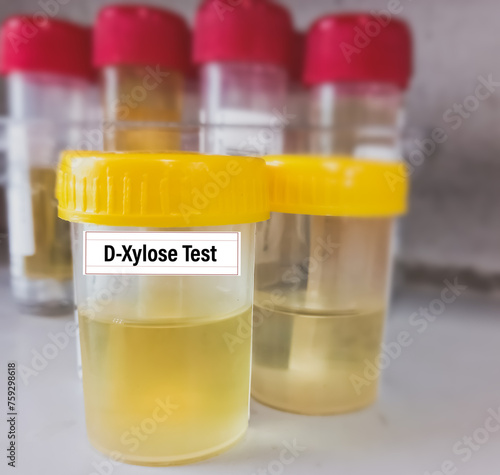 Urine sample for Xylose test, to help diagnose malabsorption disorders, that affect your ability to digest and absorb nutrients from food. xylose tolerance test, xylose absorption test, D-xylose test. photo