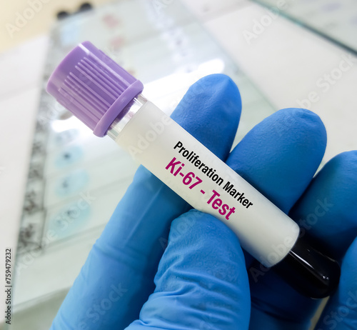 Blood sample for Proliferation marker Ki-67 test, to diagnosis of breast cancer. photo