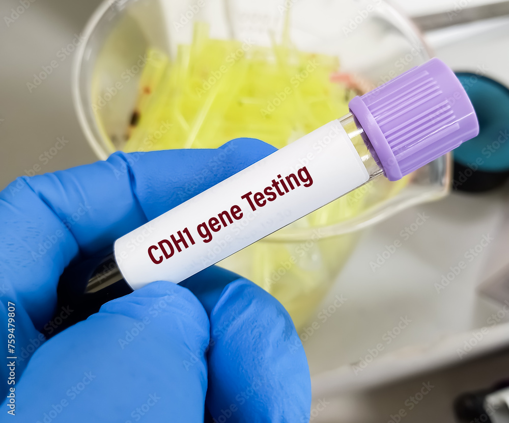 Blood sample for CDH1 gene mutation testing to diagnosis of Hereditary Diffuse Gastric Cancer. Genetic testing. Blood sample for CDH1 gene mutation testing to diagnosis of Hereditary Diffuse Gastric Cancer. Genetic testing.
