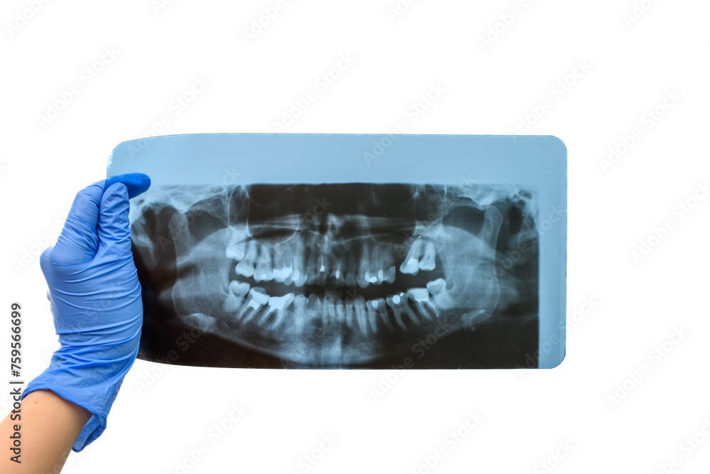 Dentysta trzyma w dłoni pantomogram panoramiczne zdjęcie zębów  - obrazy, fototapety, plakaty 