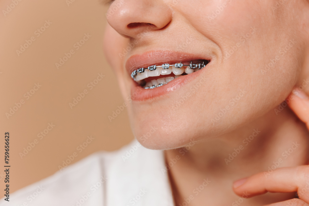 Obraz premium Close-up of a woman with braces on a beige background