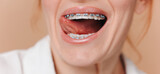 Close-up of a woman touching braces with her tongue