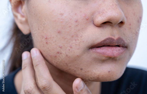 An Asian teenage girl with uneven facial skin problems. The invasion of acne, inflamed acne, clogged acne, pustules, chronic acne problems Redness on cheeks. Sensitive skin. Skin care concept.