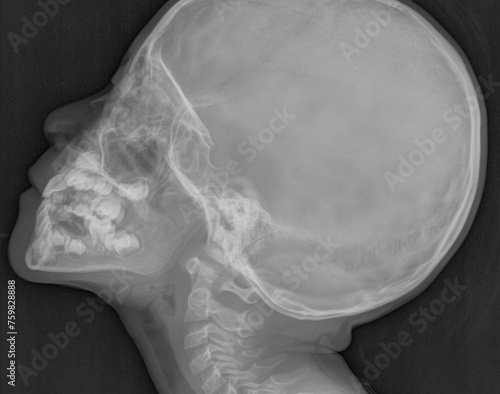adenoid enlargement  , Skull lateral soft tissues X ray
