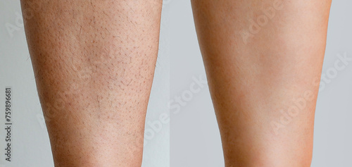 Image before and after woman's Legs hairs removal, skin care treatment for smooth skin concept.