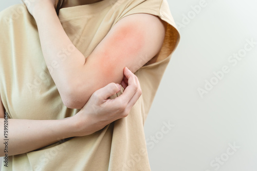 young woman scratching on her arm and has a red rash irritation on her skin from dust intolerance.