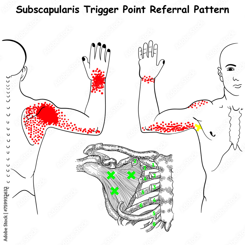 subscapularis-trigger-point-referral-pattern-vector-diagram-stock