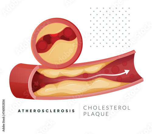 Atherosclerosis - Plaque Buildup - Stock Illustration