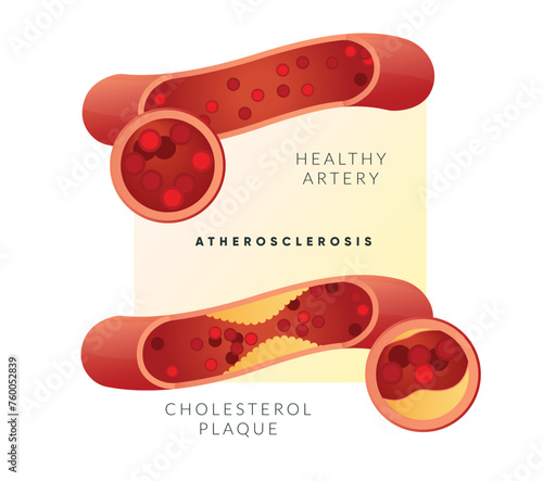 Atherosclerosis - Plaque Buildup - Stock Illustration