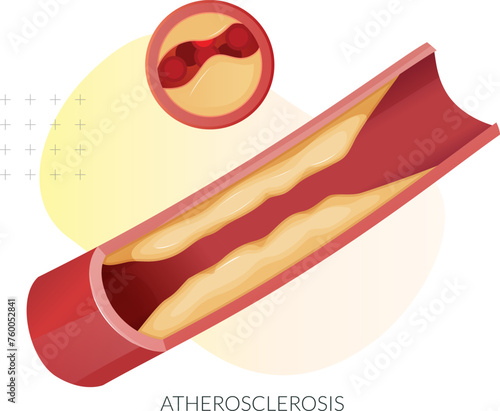 Atherosclerosis - Plaque Buildup - Stock Illustration