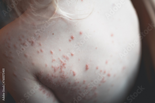 Fotografie 2 year old with severe chickenpox across body