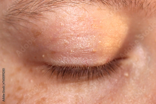 Closed eye of a girl with white dots on the skin. Milia on the skin close-up.