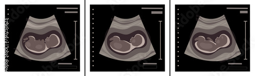 Set of ultrasound baby photo. Unborn vector picture.