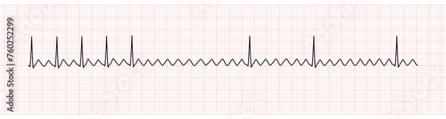 EKG Monitor Showing  Atrial Flutter with 2:1 AV Block After Adenosine Intravenous