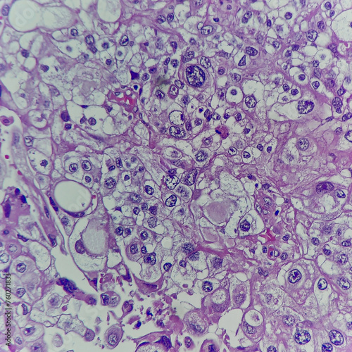 Camera photo of clear cell type of endometrial carcinoma, showing pleomorphic nuclei and clear cytoplasm, magnification 400x, photograph through a microscope