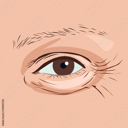 Foto Close-up crow's feet eyes and puffy eye bag area, illustration