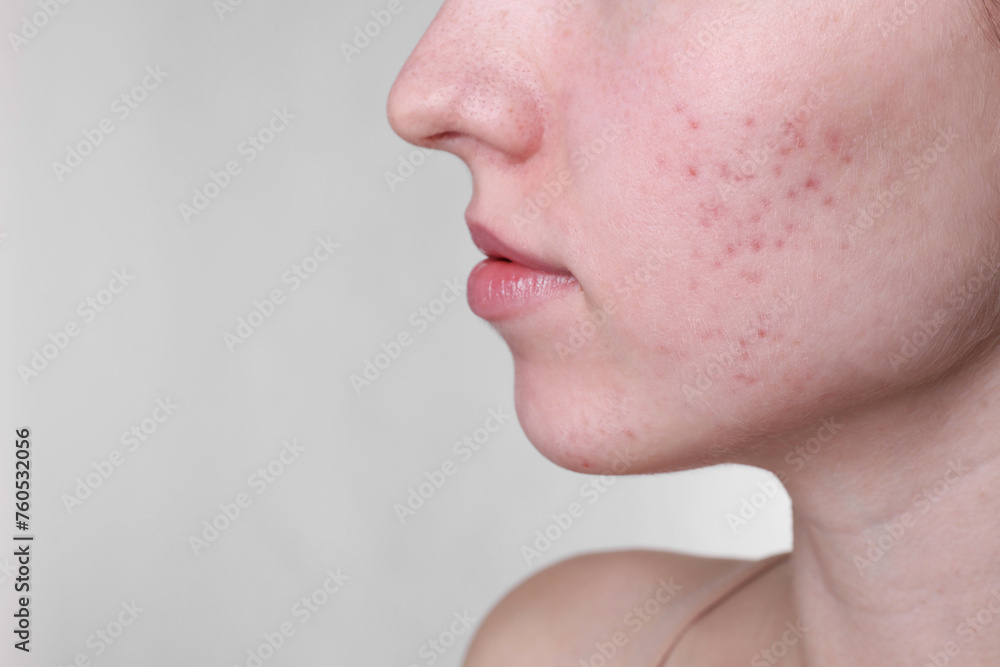 Young woman with acne problem on light grey background, closeup. Space for text Young woman with acne problem on light grey background, closeup. Space for text