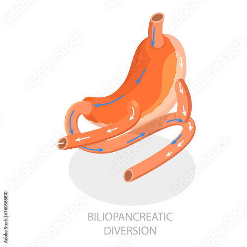 3D Isometric Flat Vector Illustration of Types Of Bariatric Surgery, Sleeve Gastrectomy. Item 1