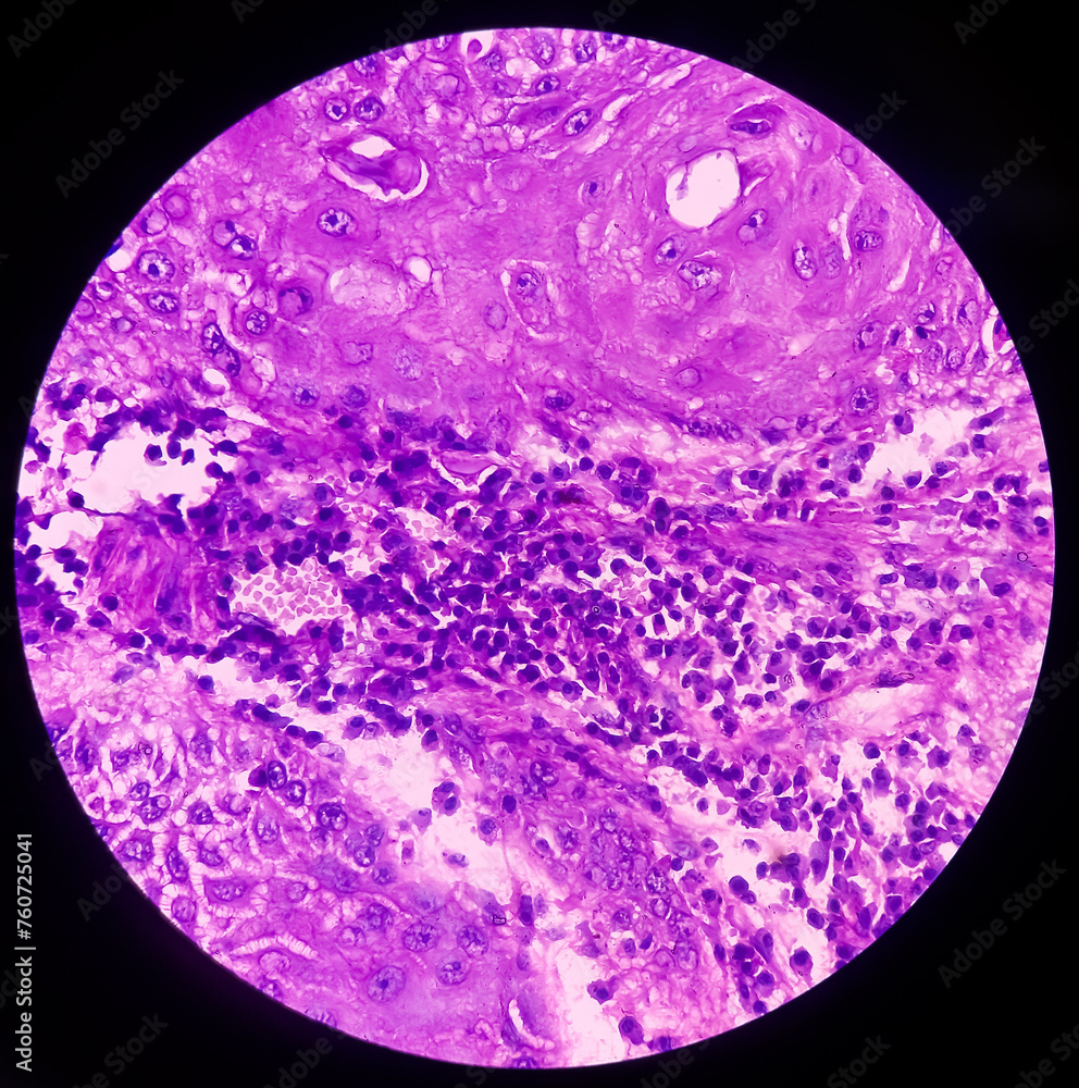 Nipple (biopsy) Invasive squamous cell carcinoma of nipple