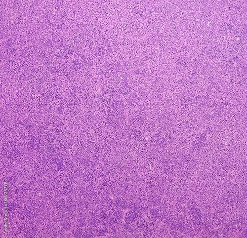 Cervical lymph node(biopsy): Non-Hodgkin's lymphoma-high grade. Light microscopically show monotonous population of atypical lymphoid cells. Malignant tumor. photo