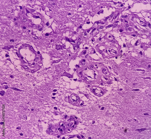 Billede på lærred Kidney cancer: Microscopic image of metastatic clear cell carcinoma of kidney, the most common type of renal cell carcinoma