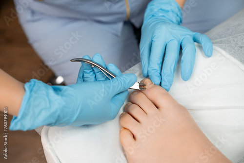 Podiatrist uses nippers cutter to remove ingrown toenail in the clinic.  photo
