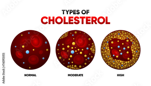 Types Cholesterol in flat style. LDL and HDl level. Arteriosclerosis, infarct, ischemia, thrombosis disease. Cholesterol in human blood vessels. Vector illustration.